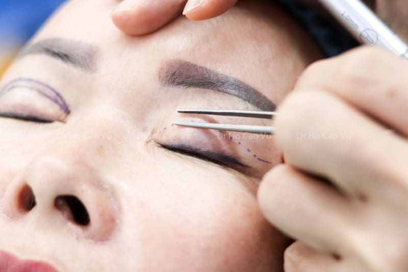 Kinh nghiệm đi cắt mí mắt: Hướng dẫn chi tiết và lời khuyên quan trọng