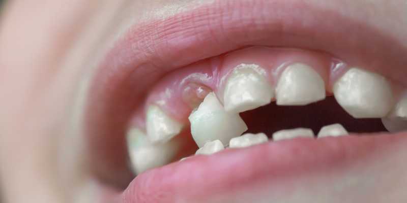 Mơ thấy rụng răng là điềm gì