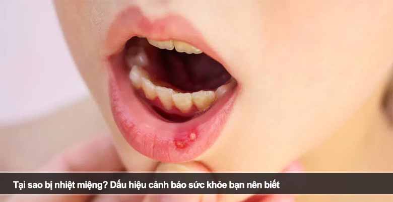 Tại sao bị nhiệt miệng? Dấu hiệu cảnh báo sức khỏe bạn nên biết 