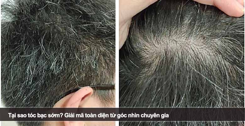 Tại sao tóc bạc sớm? Giải mã toàn diện từ góc nhìn chuyên gia 